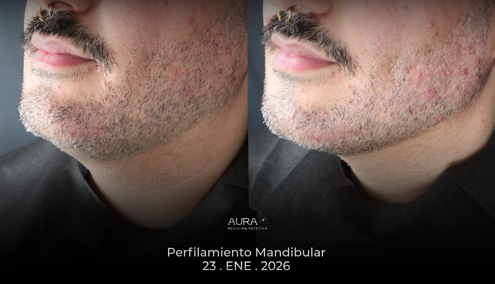 Antes y después de tratamiento facial