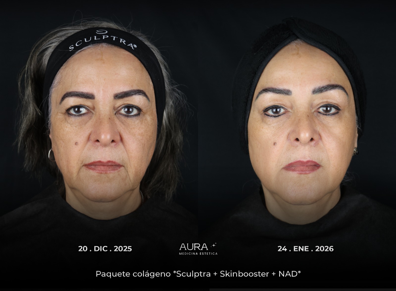 Antes y después de tratamiento estético