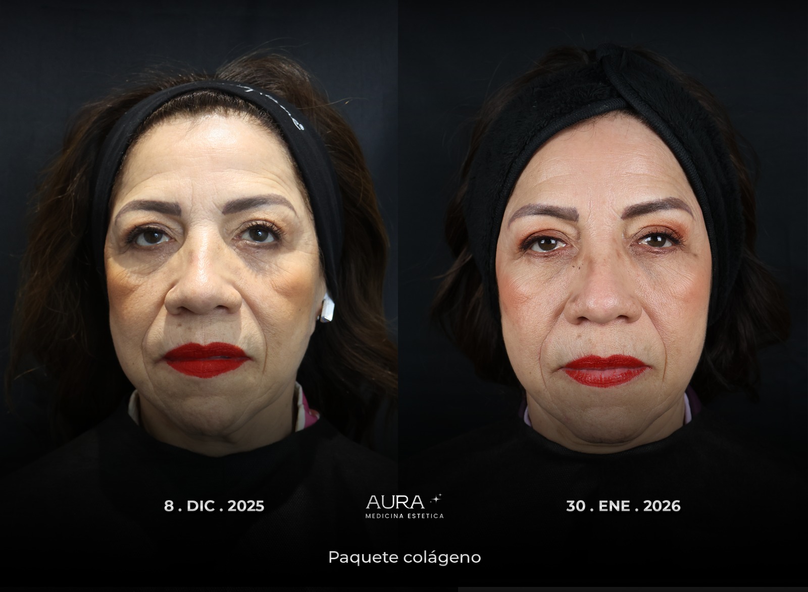 Antes y después de medicina estética