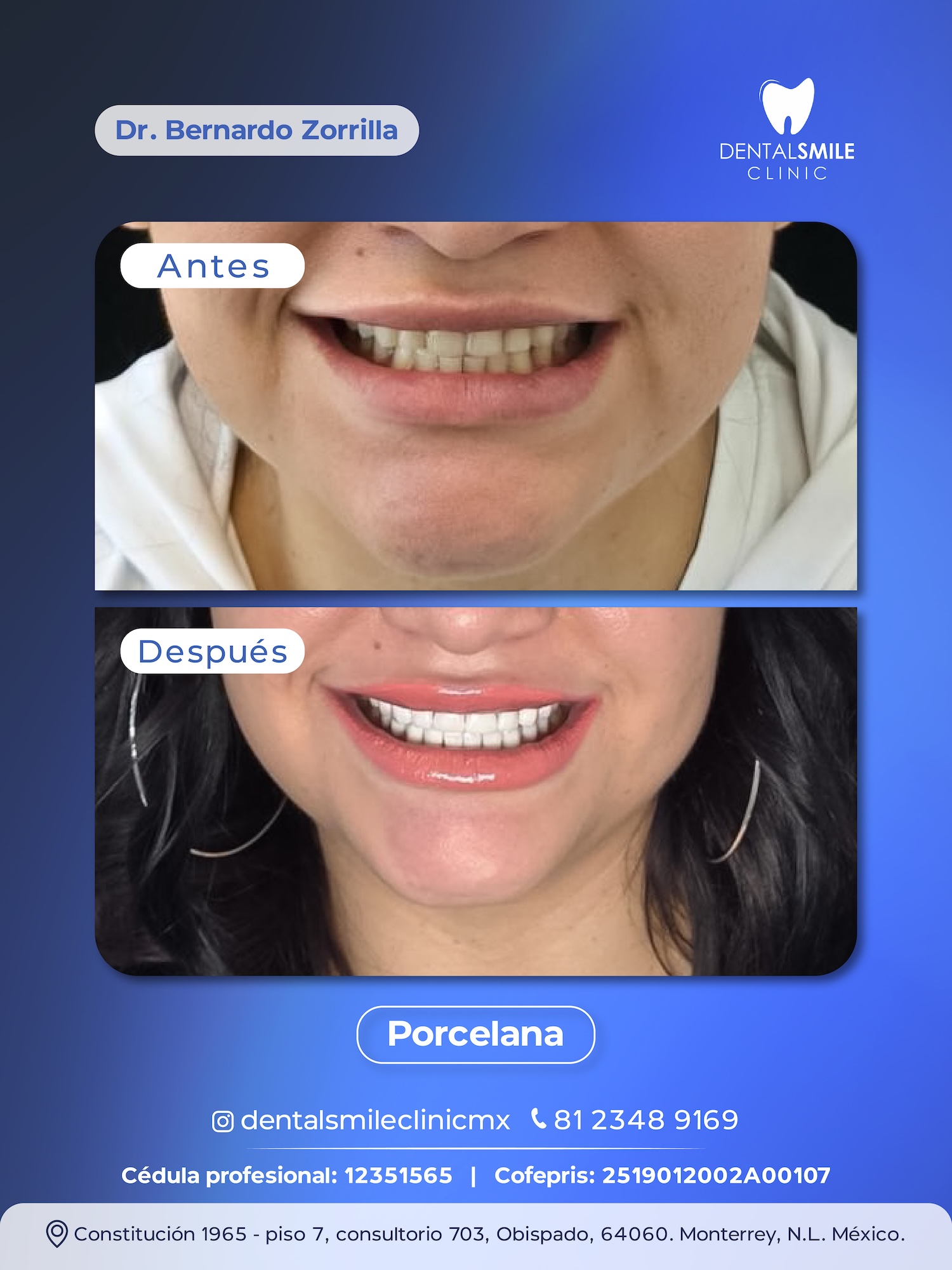 Antes y después Porcelana EMAX