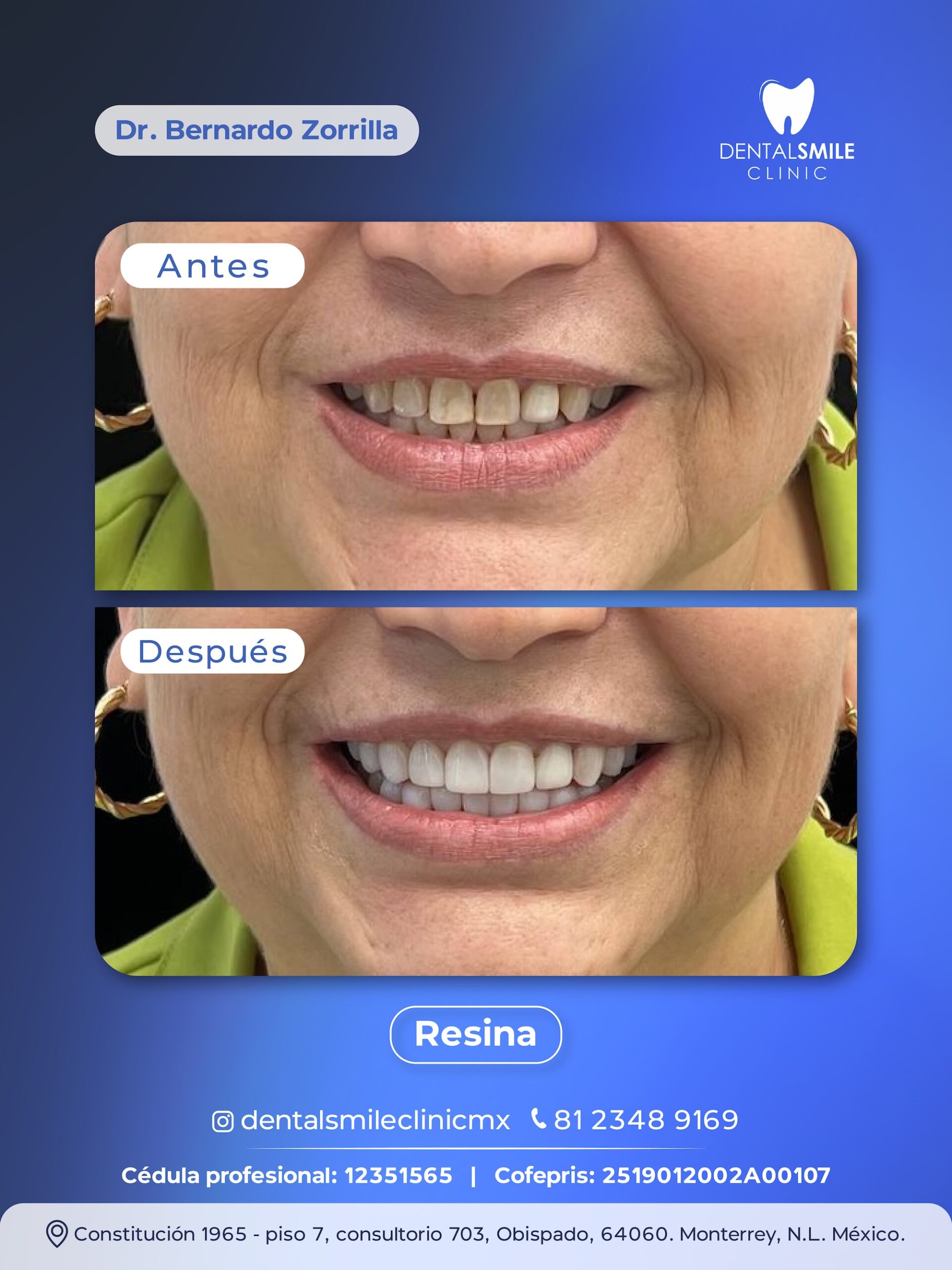 Antes y después Resina