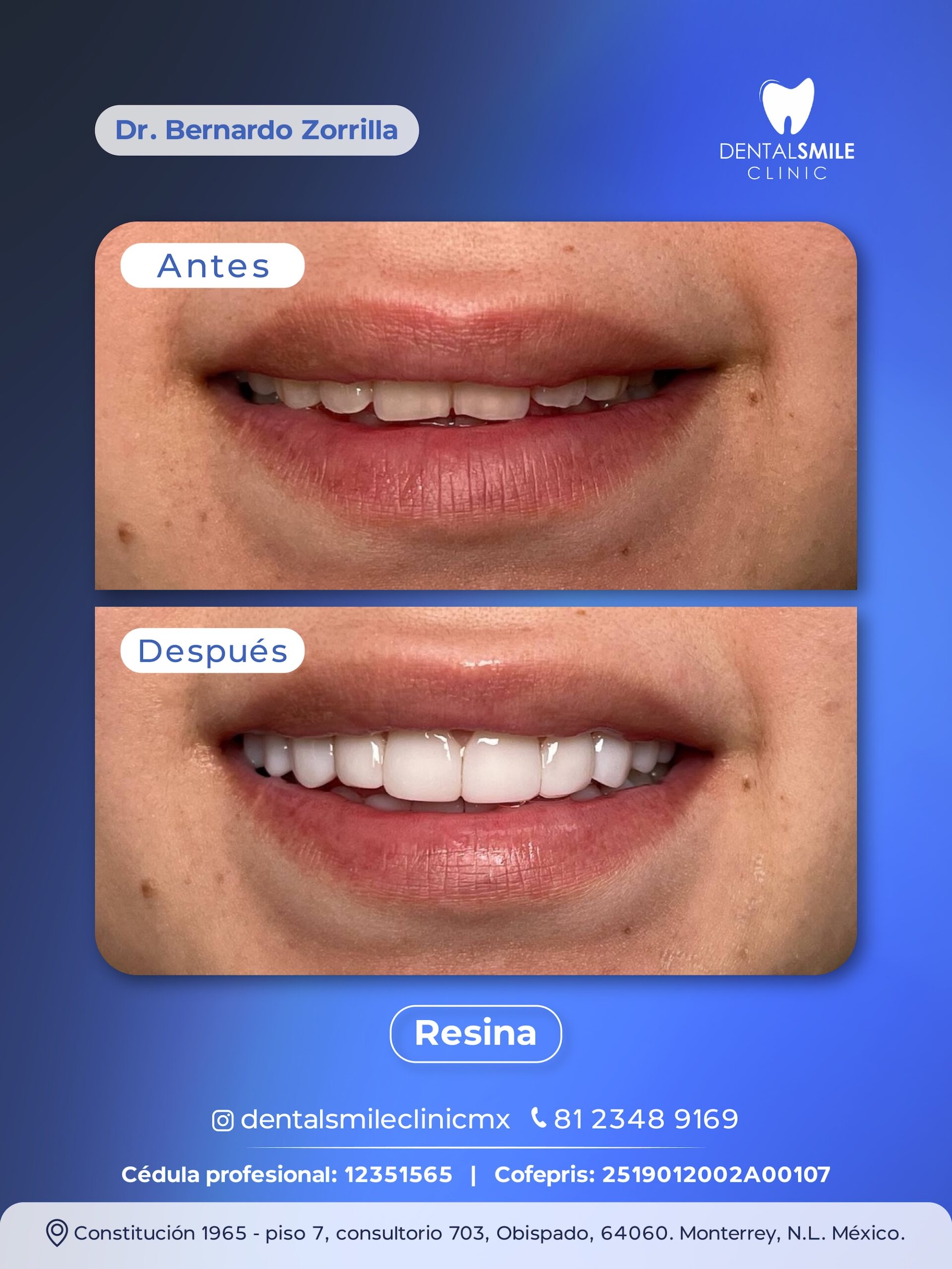 Antes y después Resina
