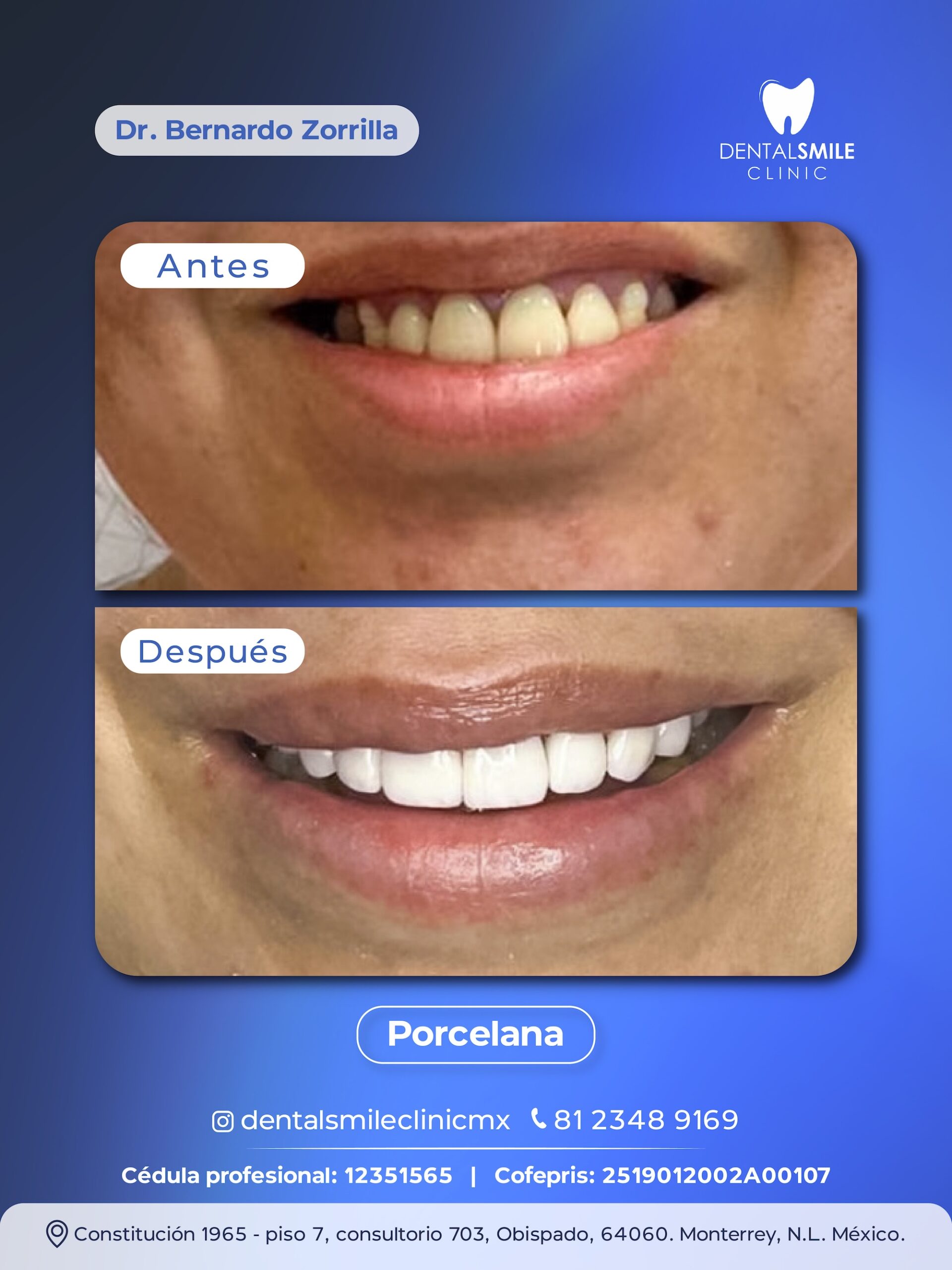 Antes y después Porcelana EMAX