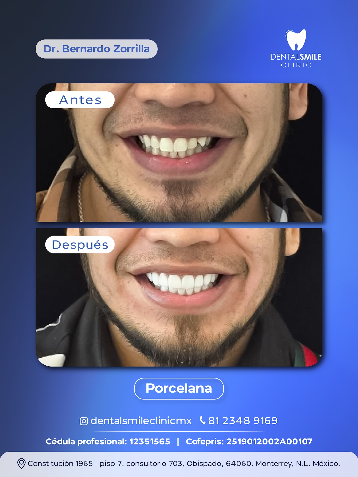Antes y después Porcelana EMAX
