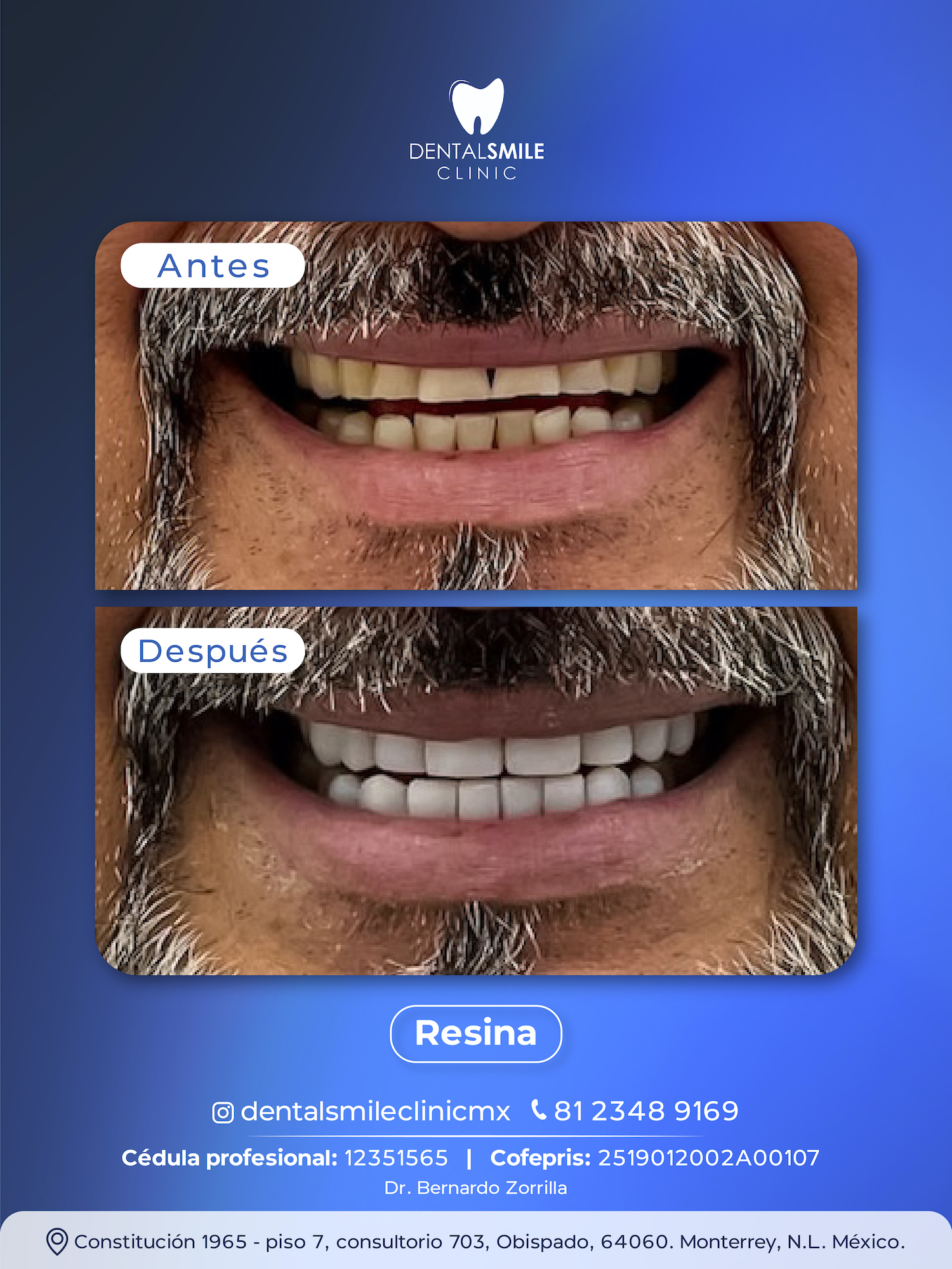 Antes y después Resina