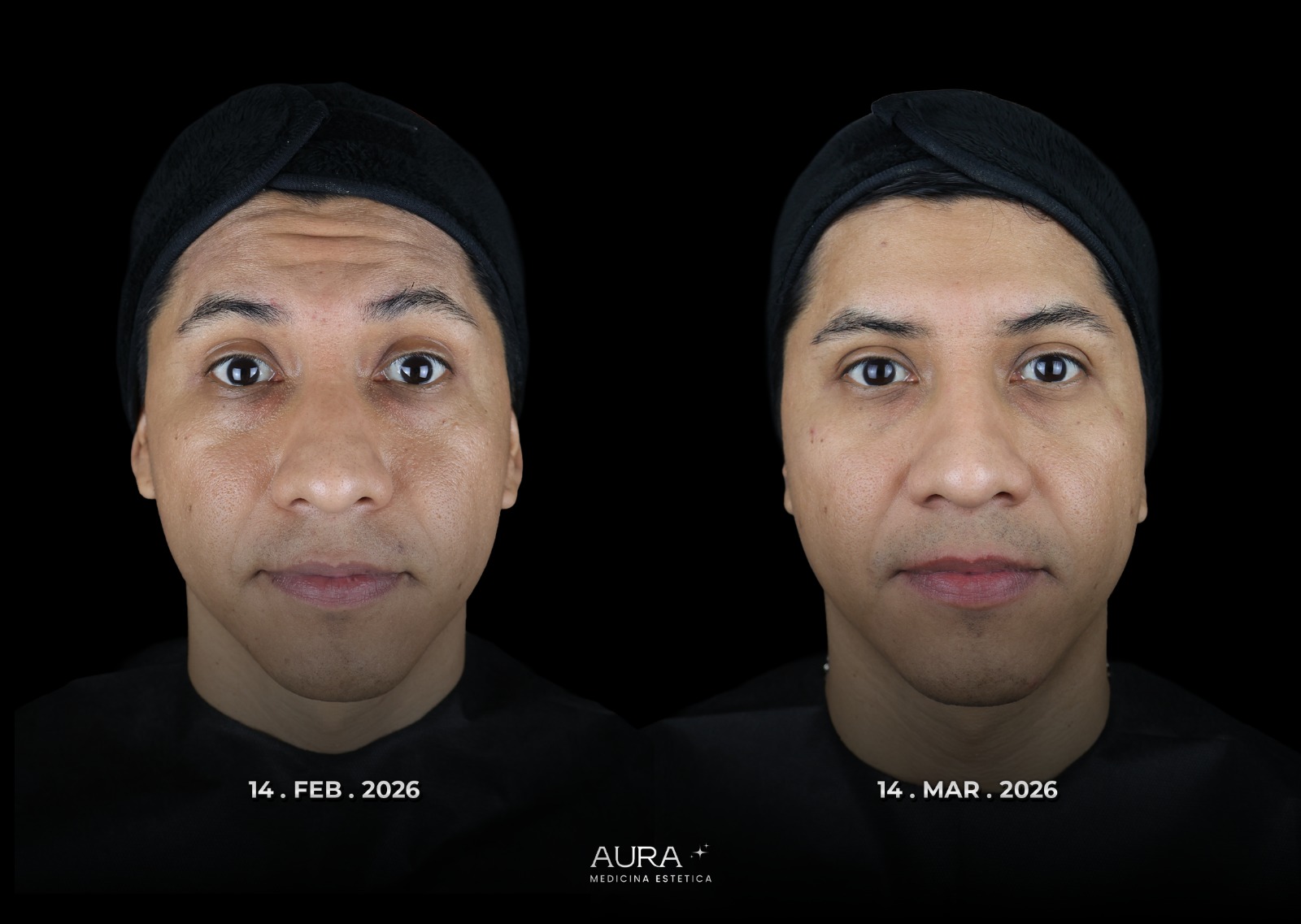 Antes y después de armonización facial