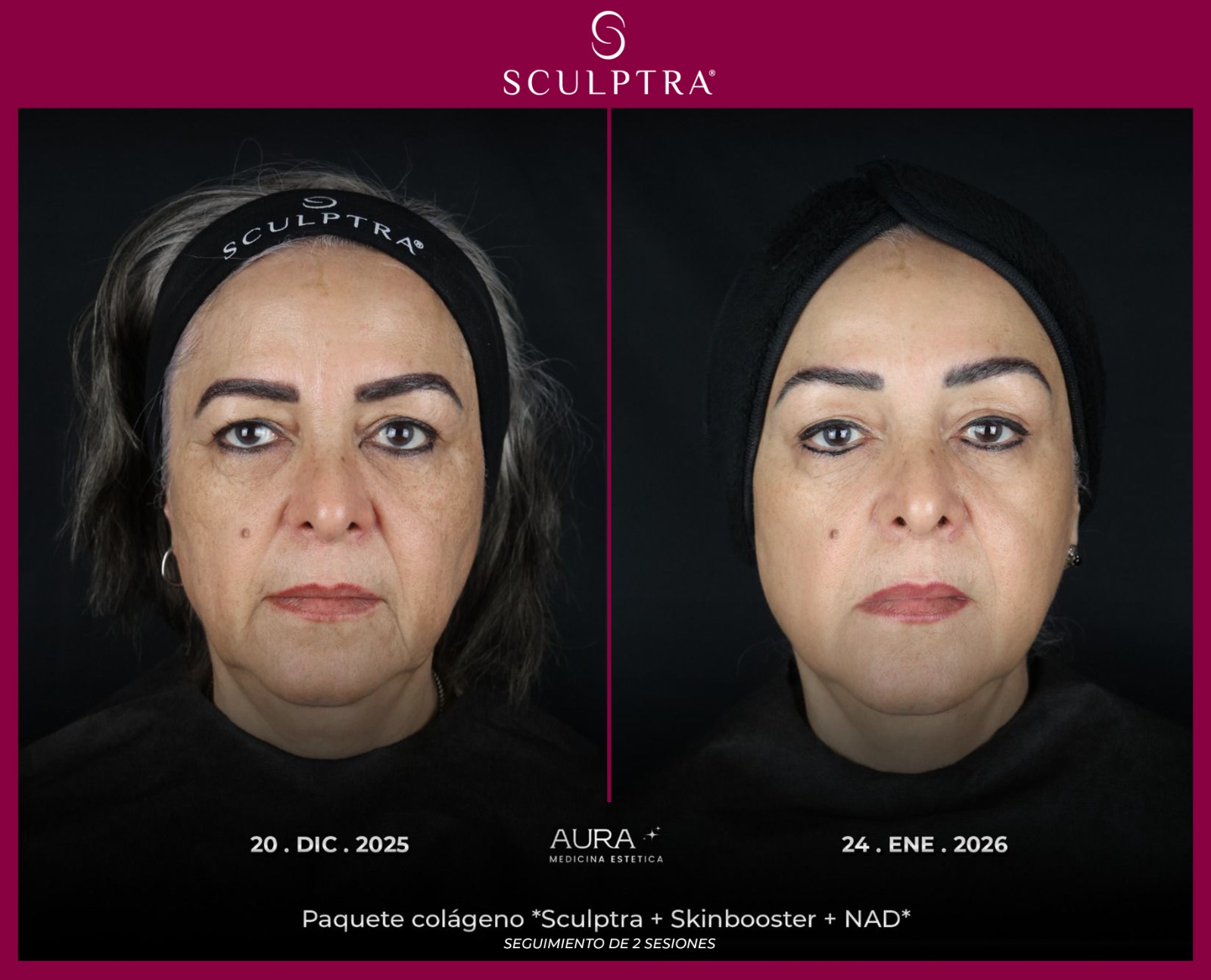 Antes y después de calidad de piel