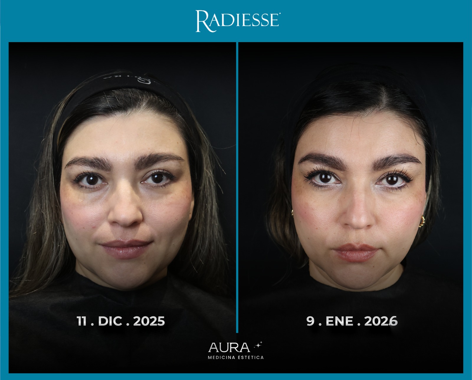 Antes y después de rejuvenecimiento facial